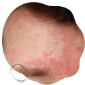 seborea, seboroická dermatitida
